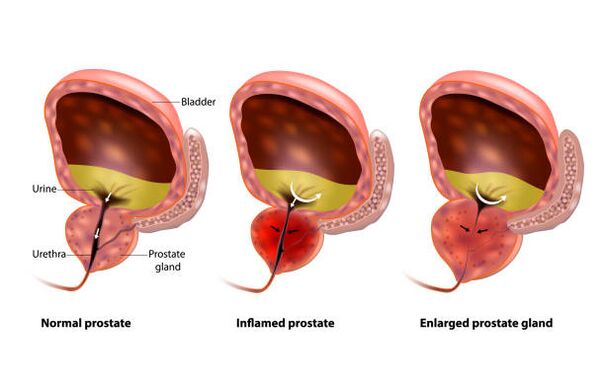 prostatitis je vnetje prostate