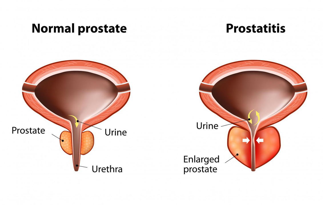 Normalna prostata zdravega moškega in vnetje prostate s prostatitisom